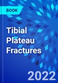 Tibial Plateau Fractures- Product Image