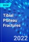 Tibial Plateau Fractures - Product Thumbnail Image